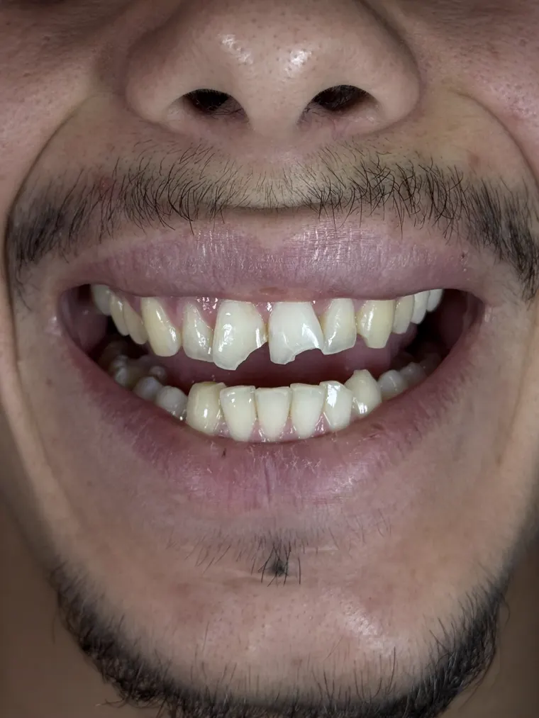 Antes