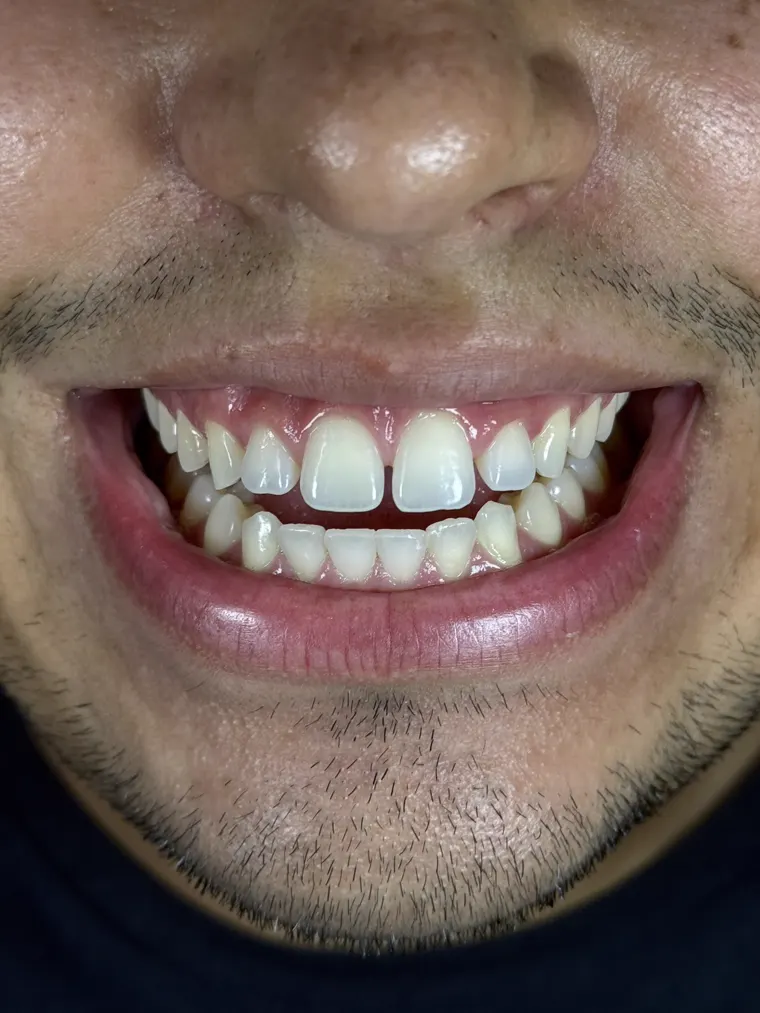 Antes